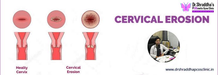 Read more about the article Platelet-rich Plasma Treatment To Cure Symptomatic Cervical Ectopy and Chronic Vaginal Discharge