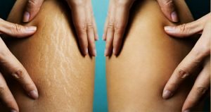 Read more about the article The Causes of Stretch Marks and The Best Ways to Prevent Them