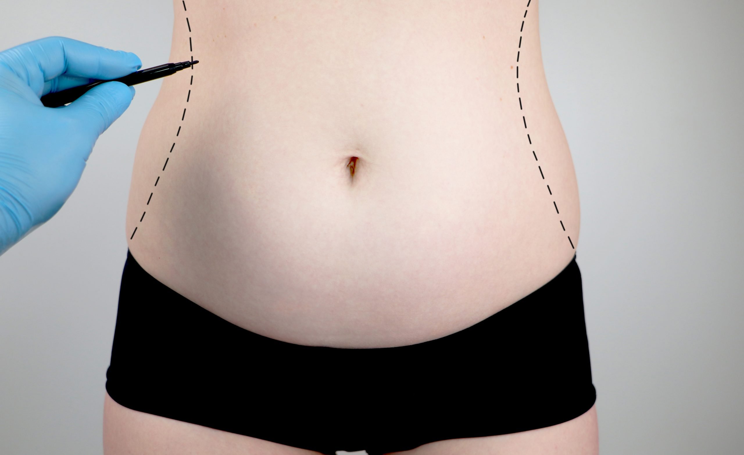 You are currently viewing The Benefits of a Tummy Tuck for Post-Pregnancy Bodies