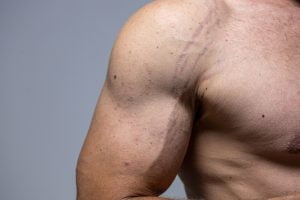 Read more about the article Stretch Marks Removal for Men: Tips and Techniques