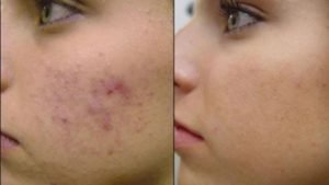 Acne Scar Treatment in Jaipur