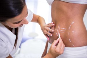 Read more about the article Liposuction of Mons Pubis: Monsplasty: Reshaping for Aesthetic Harmony