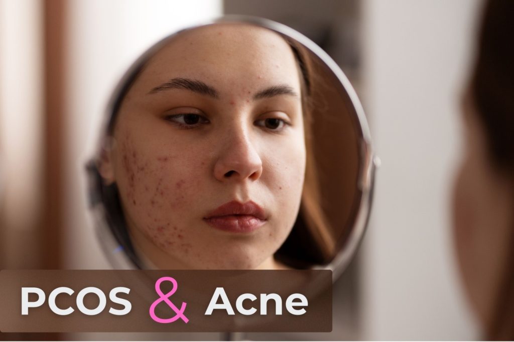 Pcod Acnes PCOS & Acne: Effective Treatments for Hormonal Breakouts