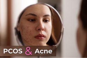 Read more about the article PCOS & Acne: How to Treat Hormonal Breakouts Effectively